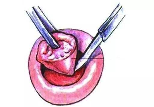 leep手术后宫颈糜烂没好,leep手术宫颈切掉后还会长出来吗