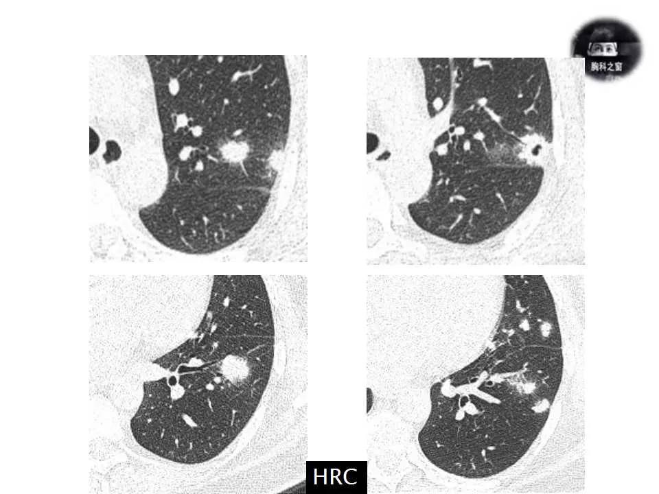 双肺多发结节是肺癌的征兆吗,双肺多发结节灶