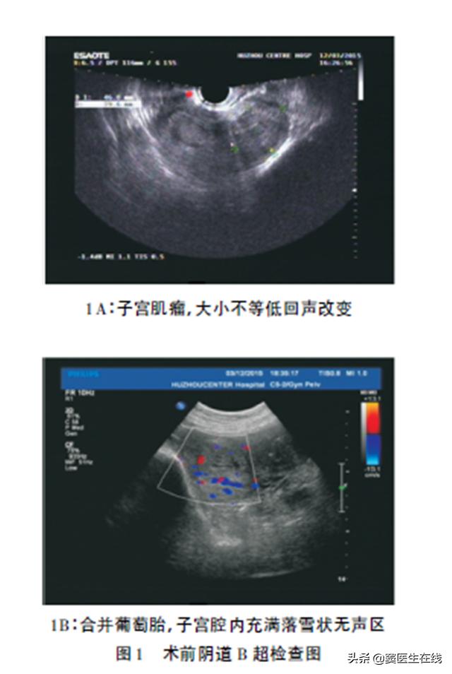 子宫肌瘤有没有可能恶变,子宫肌瘤有恶变的人多吗