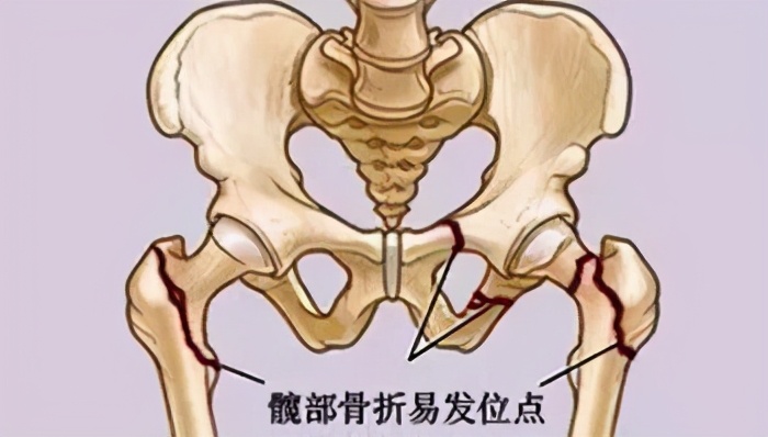 这种骨折致残率、死亡率高到难以想象!全球30%发生率在中国