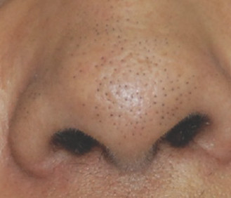 别折腾了，你这样去黑头是没有用的！