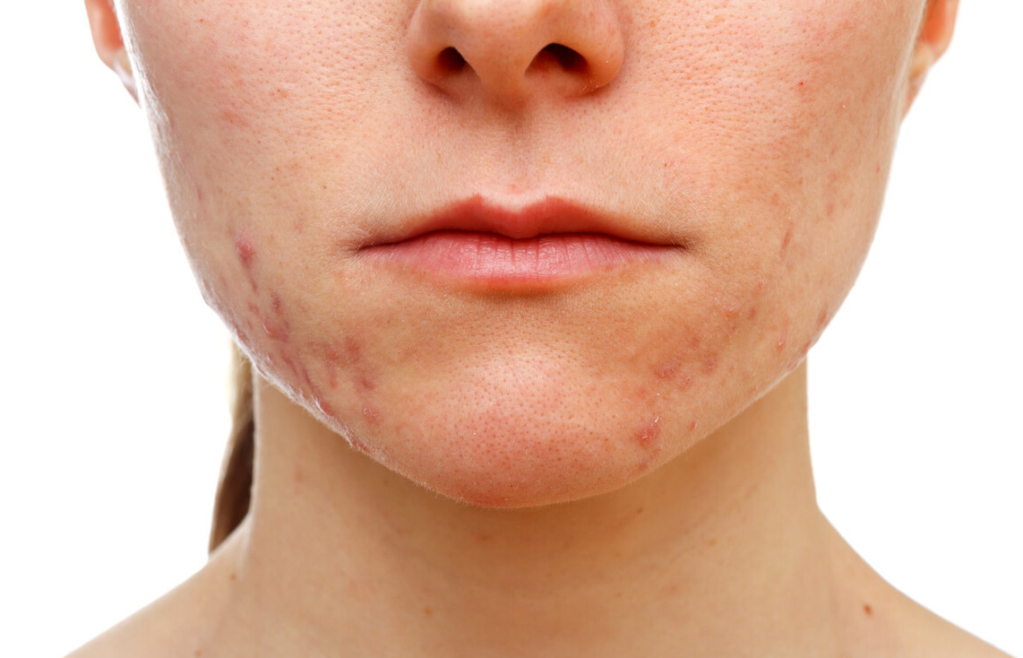 长痘到底该怎么办啊,长痘上火了怎么办