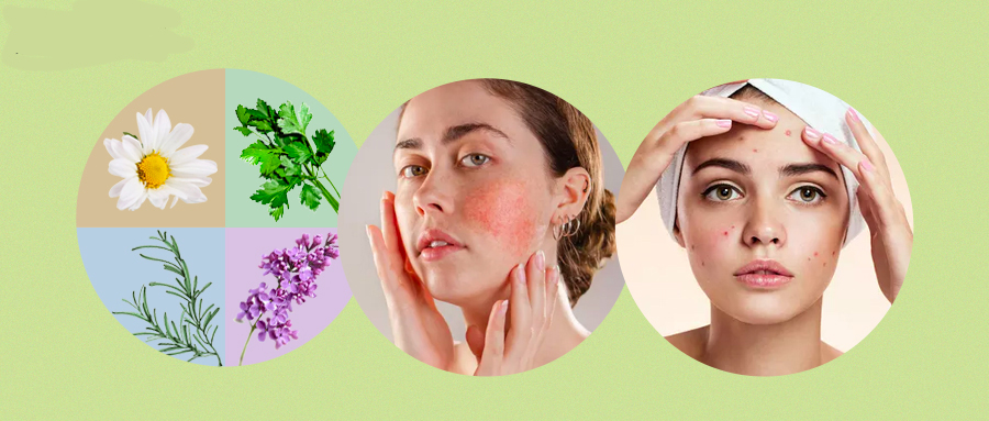 专业祛红血丝修复敏感肌,修复红血丝脸部精油