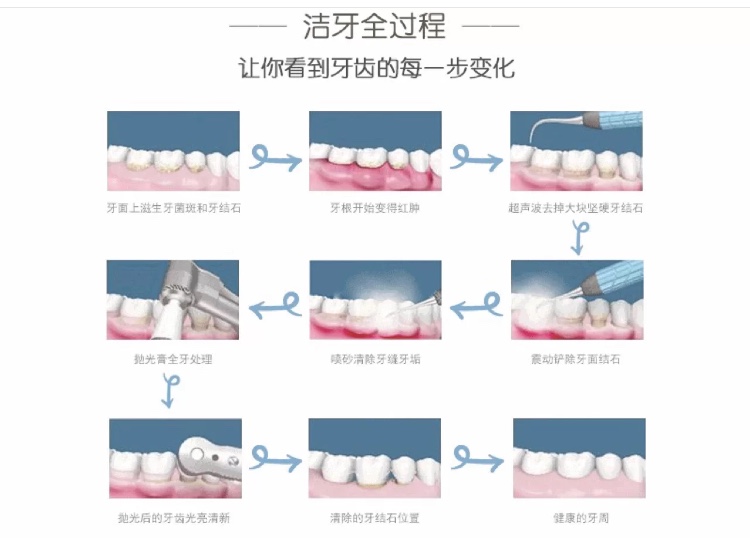 洗牙真的不好么牙医告诉你真相,一个牙医的良心忠告洗牙的利与弊