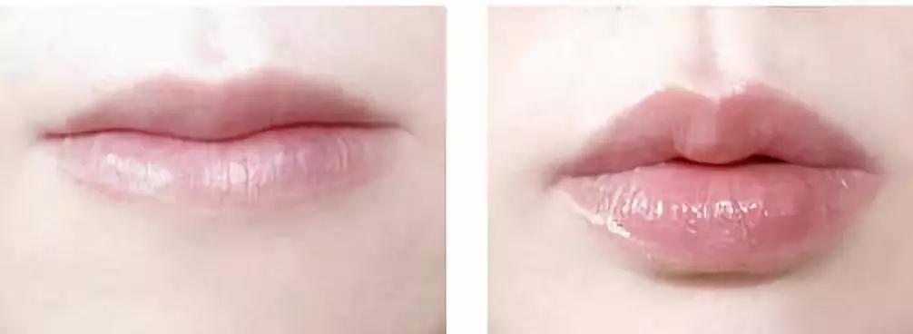 打造嘟嘟唇正确手法视频,嘟嘟唇整容手术过程