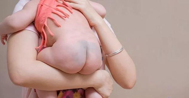 为什么刚出生的婴儿屁股上有青迹,为什么婴儿出生屁股会淤青