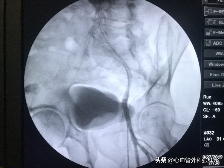 外周血管治疗图,外周血管疾病怎么治