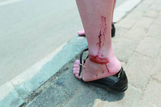 儿童手指夹伤怎么处理,三岁女童手指被压断后续