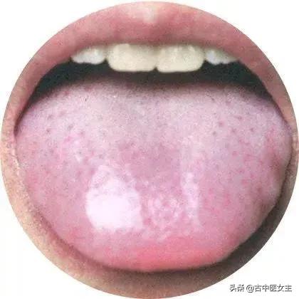 风热风寒感冒区别,风寒感冒八纲辨证