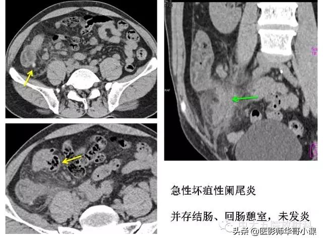 阑尾炎课件,阑尾炎的超声课件