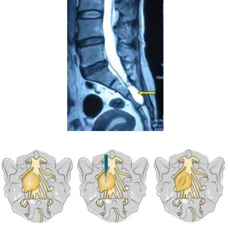 尾椎骨下方屁股两处反复长水泡,尾椎骨附近起了水泡是怎么回事