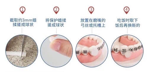 矫正牙齿在牙龈打钉子多久能取,整牙一定要在牙龈里打钉子吗