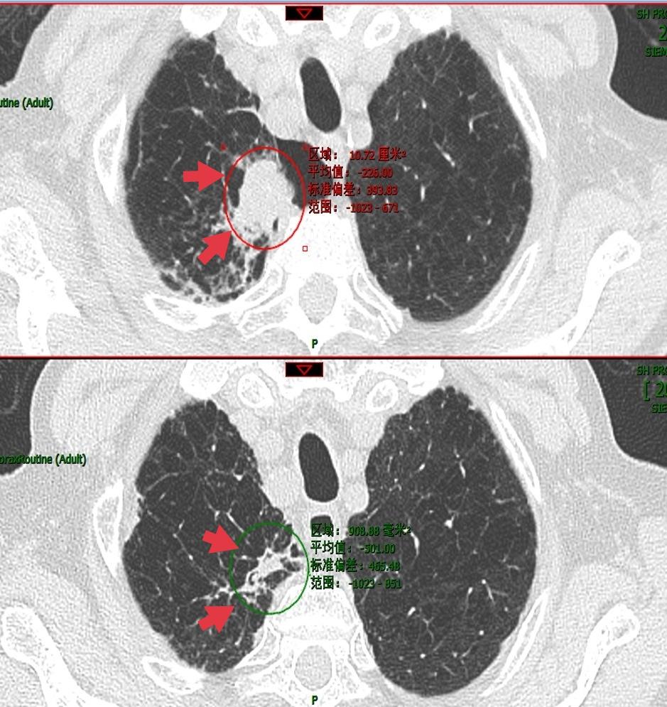 肺结节抗肿瘤治疗,肺结节诊治实例