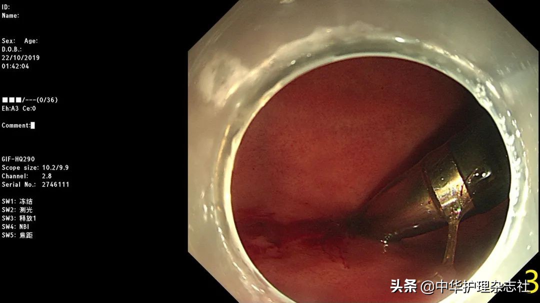 误吸患者护理的应急预案,幼童误吞电池医生顺利取出