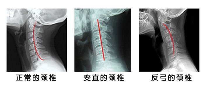 颈椎病乳胶枕和荞麦枕哪个好,乳胶枕对颈椎病有用吗