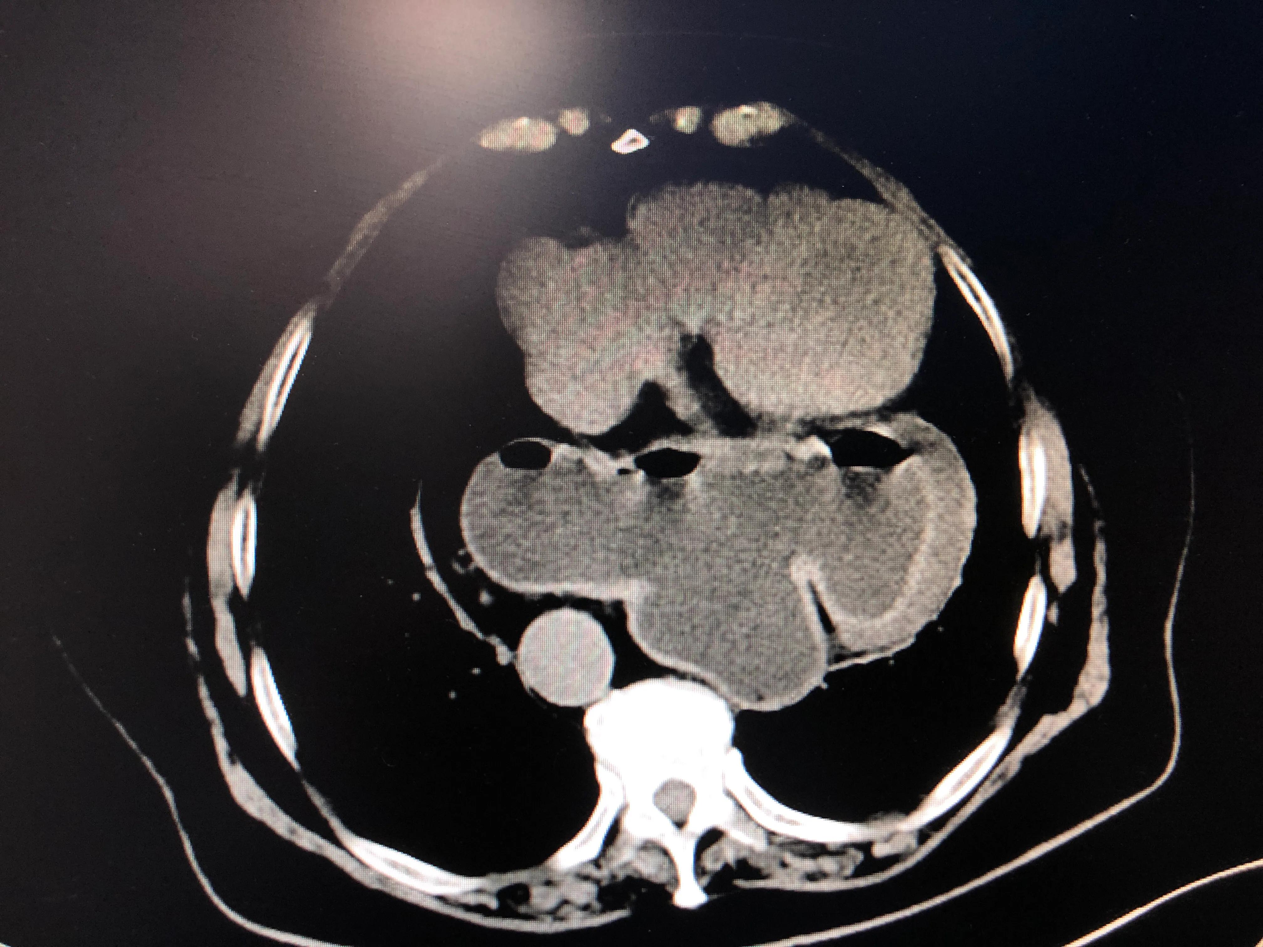 胃跑到胸腔了怎么办,胃跑到胸腔里做什么手术