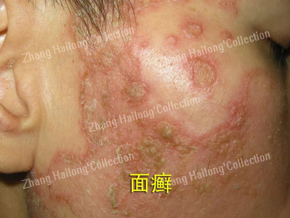 孩子脸上长癣怎么办,孩子脸上长癣是怎么回事啊