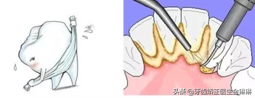 洗牙后舌头总是麻麻的怎么办,洗牙一直咽口水怎么办