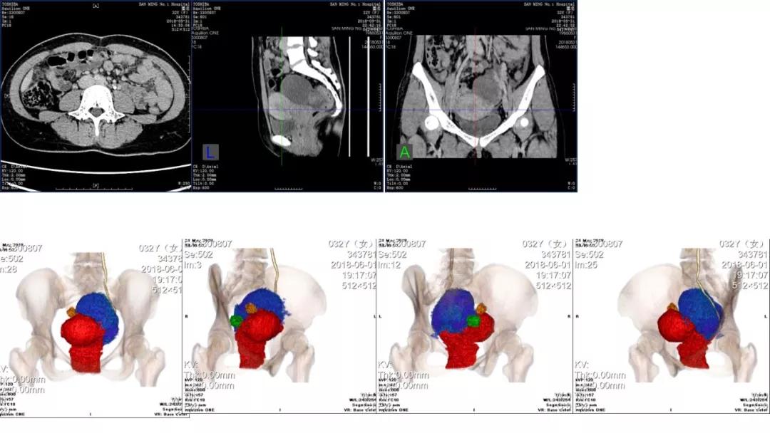 卵巢原发肿瘤的分析思路