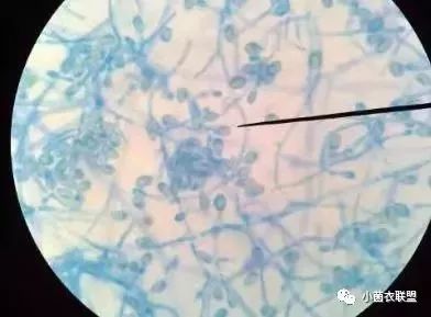 治愈脚气我有绝招,脚气太难治愈