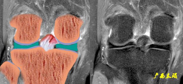 交叉韧带损伤的mr表现,后交叉韧带损伤的诊断实验