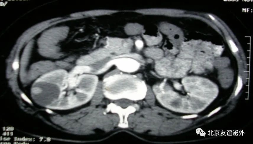 体检发现肾囊肿了怎么办?