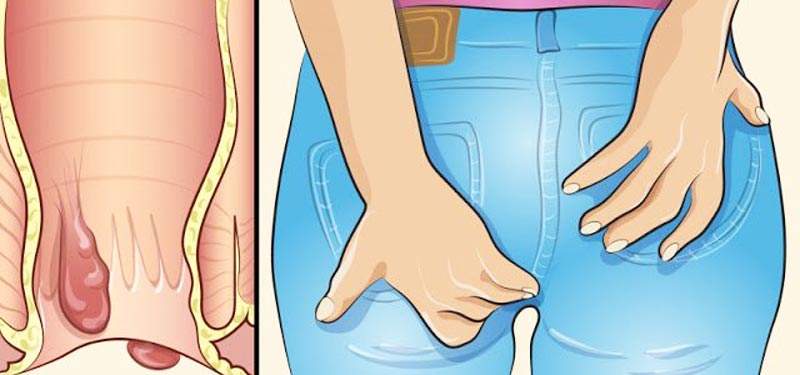 肛门周围瘙痒是什么原因怎么治疗,肛门周边瘙痒是什么原因怎么治疗