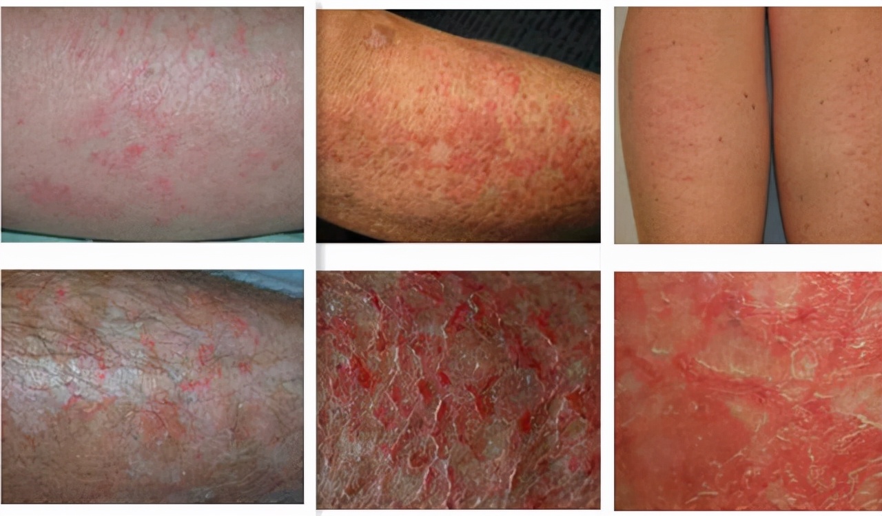 在春季怎样有效预防皮炎的复发,春天换季面部皮炎的10种症状图