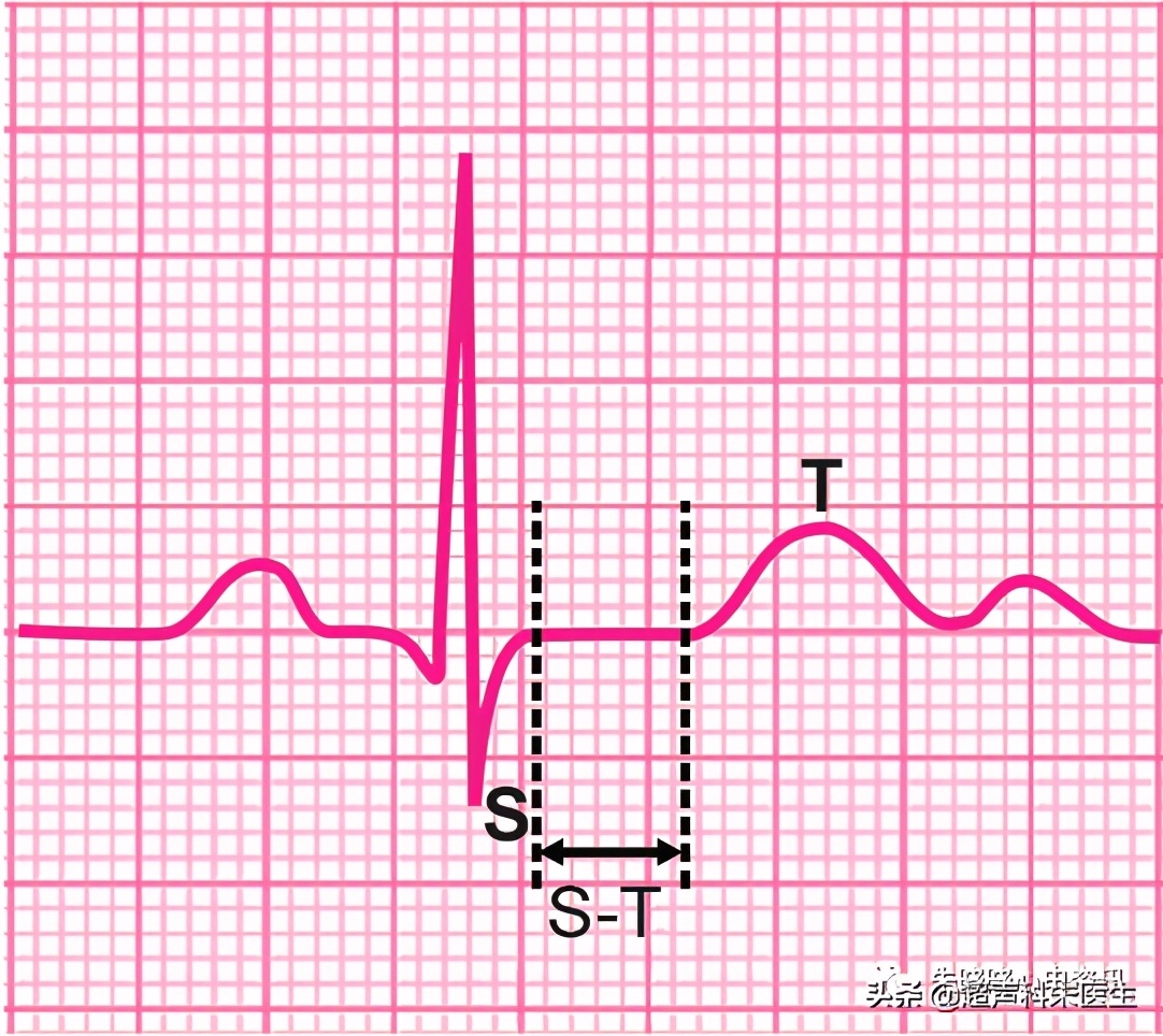 t波倒置9个真相图解,t波倒置判断口诀
