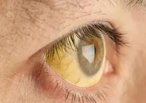 小孩黄疸17.5严重吗,小孩黄疸17.1