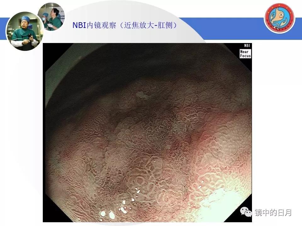 低分化胃癌早期时候做内镜手术吗,早期胃癌内镜手术后追加外科手术