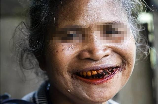 槟榔会致癌到底是不是真的,槟榔致癌是公认的吗