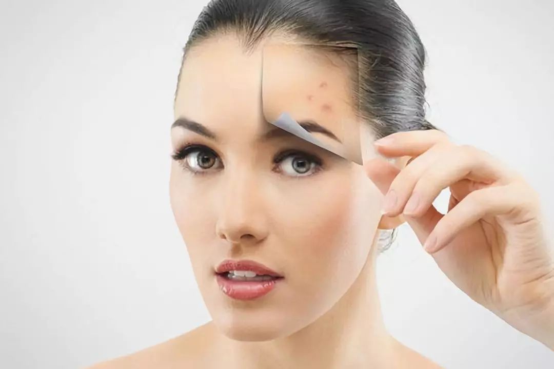 脸上长闭口痘痘用什么护肤,脸上很多闭口怎么护肤