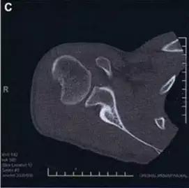 特殊骨折类型,特殊骨折体征