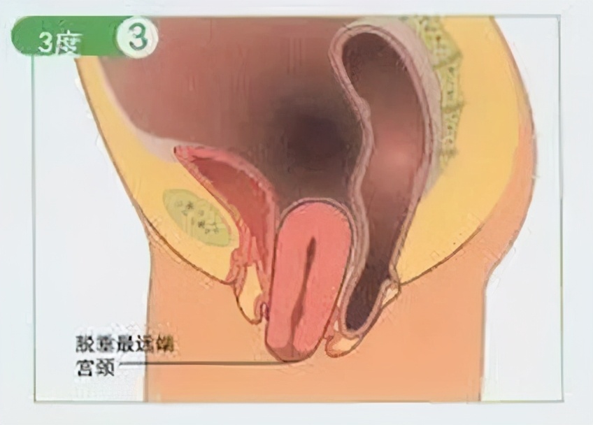 产后子宫脱垂膨出的症状怎么恢复,产后阴道膨出脱垂的症状