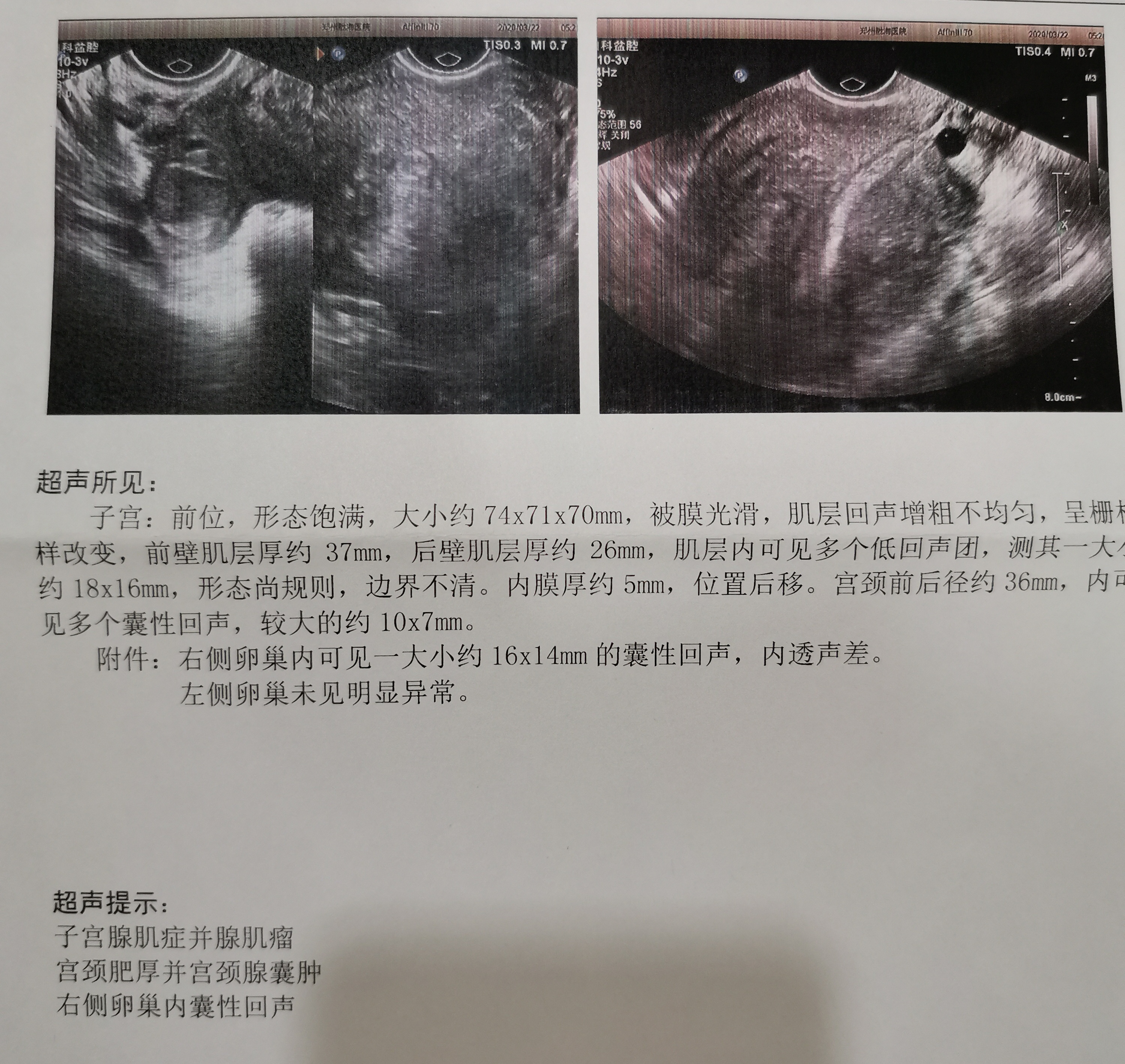 为什么子宫腺肌症不推荐介入,保留子宫和切除子宫的利弊