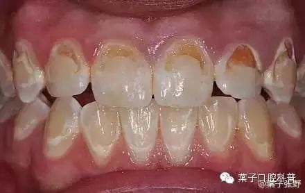 牙套人在学校怎么刷牙,如何戴着牙套正确刷牙