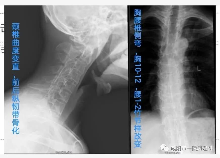 强直性脊柱炎被称不死的癌症,强直性脊柱炎不死的癌症