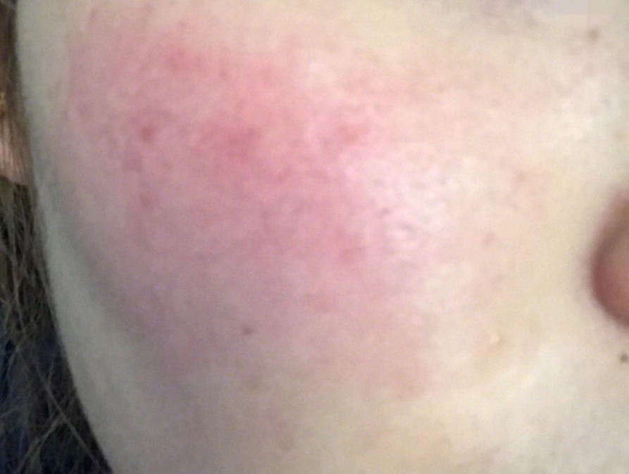 脸红血丝怎样改善和修复,眼睛红有血丝怎么回事如何去除