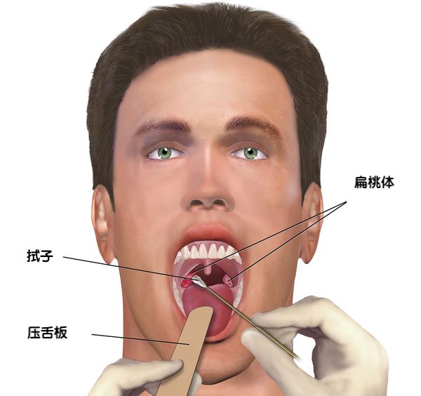 为什么医生看肺炎要做ct,新型肺炎ct特点