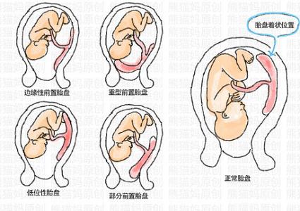 女性朋友：妊娠晚期阴道出血的原因是什么？如何防治