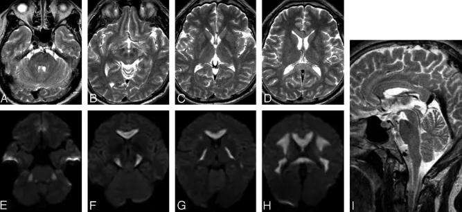 胼胝体有什么症状,胼胝体形态较小可以治疗吗