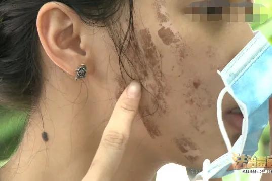 广西女子毁容后续,一妇女惨遭毁容
