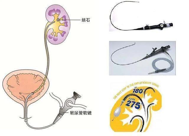 尿路结石治疗方法,女性尿路结石的治疗方法有哪些