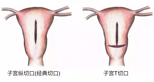 一胎剖二胎间隔7年刀疤会薄吗,计划生育头胎跟二胎间隔多长时间