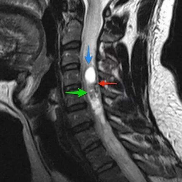 核磁共振显示骨髓水肿该怎么治疗,核磁怎么看骨髓水肿