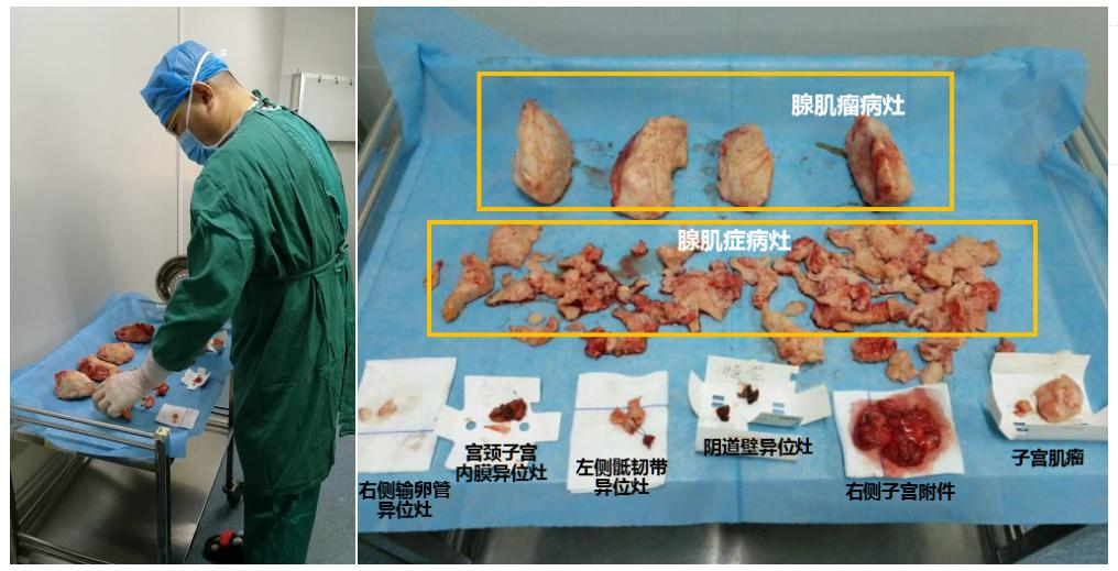 痛经有可能是腺肌症吗,警惕妇科疾病