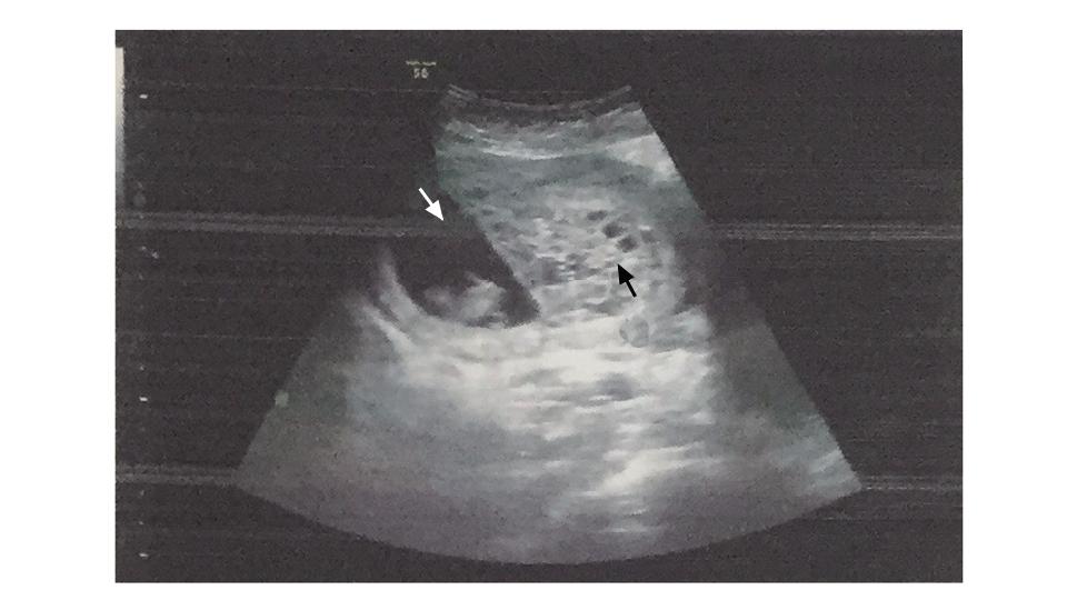 极为罕见！怀了双胞胎，却有一个是葡萄胎？高龄宝妈葡萄胎16周成功引产于阴道分娩