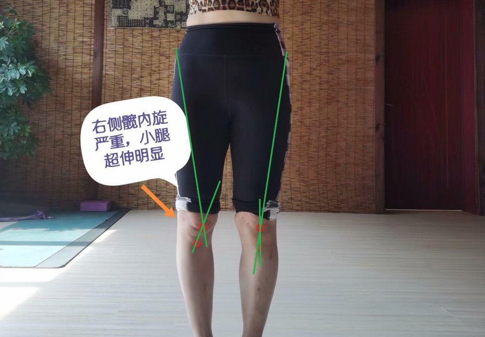 小腿外翻膝超伸如何改善,单侧膝超伸导致腿短一点