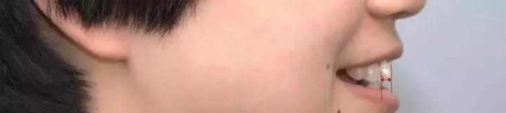 深覆盖vs深覆合,深覆盖和深覆合哪个难度大